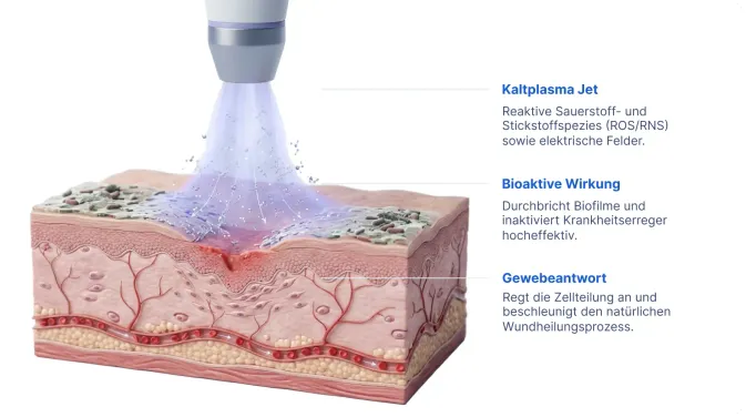 Infografik zur Wirkung des Kaltplasma-Jets auf Hautgewebe mit den Stufen Kaltplasma-Jet, bioaktive Wirkung und Gewebeantwort.