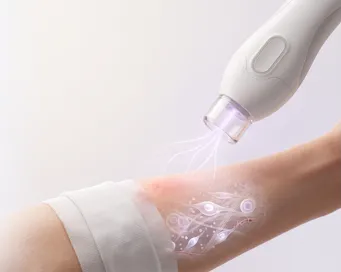 Kaltplasma-Handstück bei der Anwendung auf der Haut einer Hand